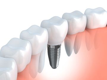 Ein Zahnimplantat in einer Zahnreihe vom Zahnarzt für Implantologie in Wien